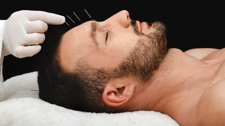 Smiling man with closed eyes receiving acupuncture treatment in forehead