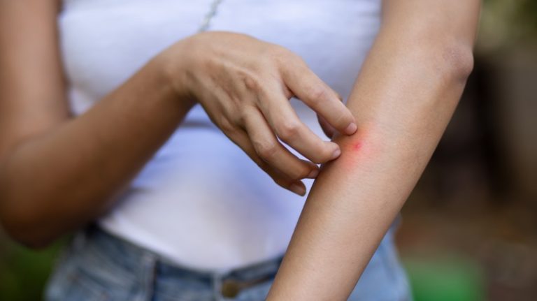 woman scratching mosquito bite